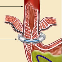 Boston Medical Center Offers New Gerd Treatment