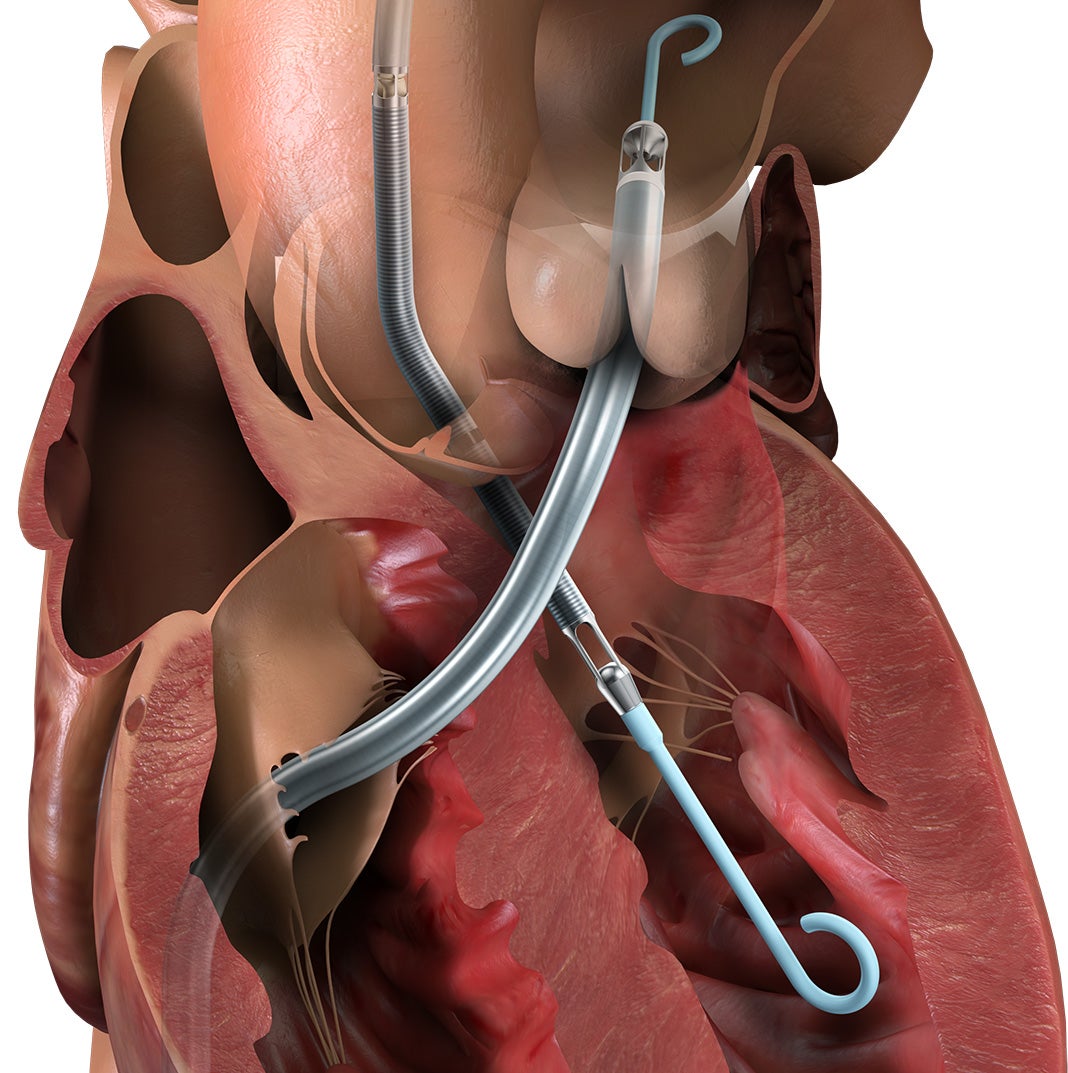 The Impella Is the World's Smallest Heart Pump
